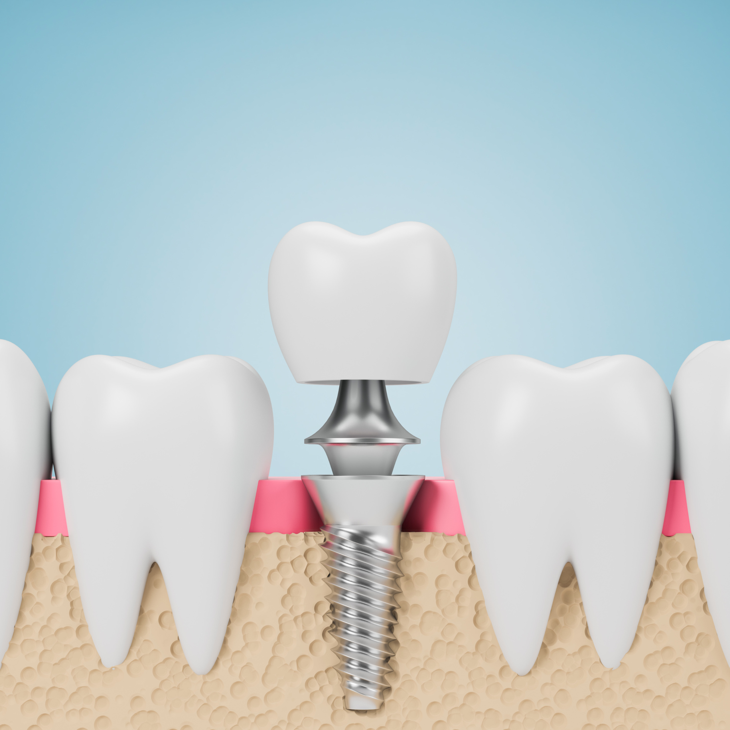 ein-zahn-implantat